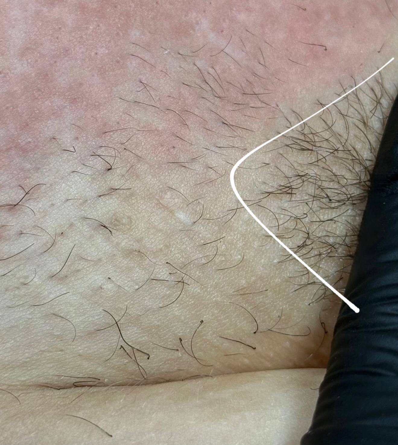Elektroepilacja bikini: granica opracowanej strefy